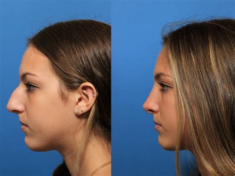 The Easiest Way To Find Non Surgical Nose Job Near Me Nose Job