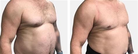 Male Liposuction Before And After New