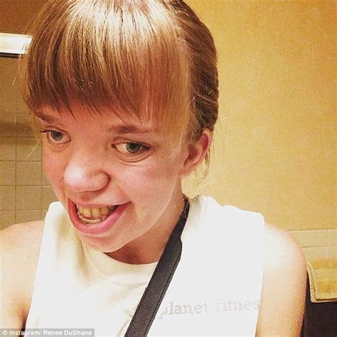 woman with genetic disorder and kylie jenner launch anti bullying campaign daily mail online
