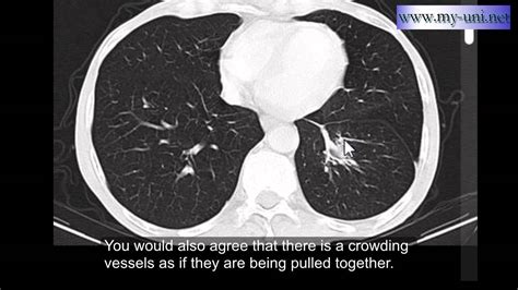Rounded Atelectasis Ct Scan Of Chest Youtube