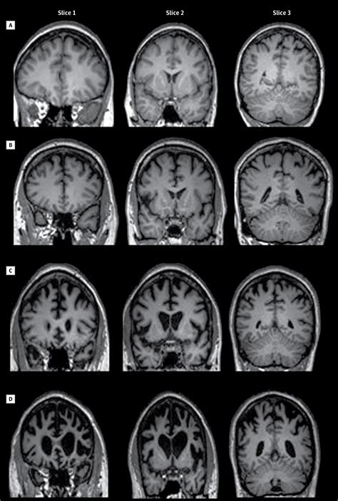 Frontotemporal Dementia and C9ORF72 Mutation | Amyotrophic Lateral ...