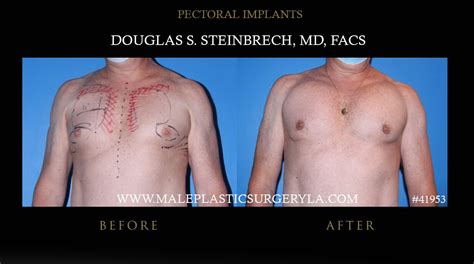 pectoral implants gallery male plastic surgery los angeles