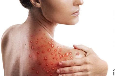Tripofobia en la piel una condición que causa malestar Vibra