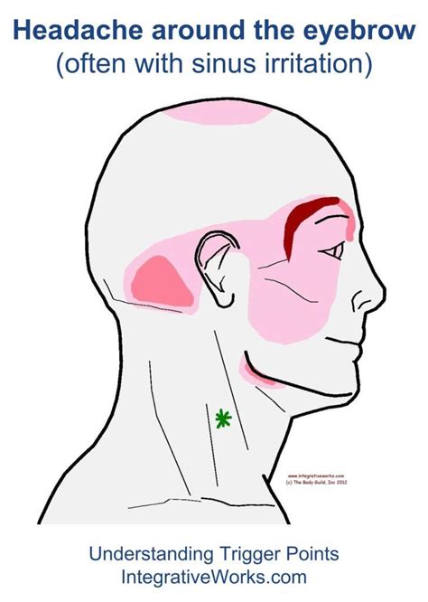 Headache Around The Eyebrow Integrative Works Trigger Points