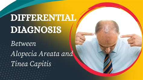 Differential Diagnosis Between Alopecia Areata And Tinea Capitis