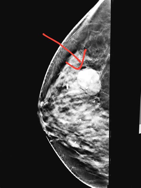 Mammograms Of Breast Cancer Images Integradas En Salud