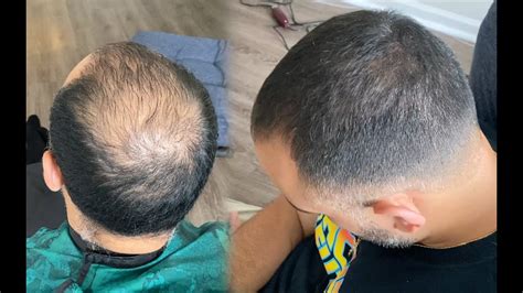 Update 80 Hairstyles For Crown Balding Men Latest Ineteachers