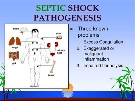 Ppt Septic Shock Powerpoint Presentation Free Download Id1715724