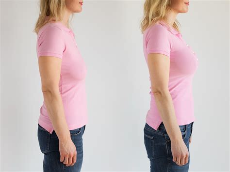 Why Are More Moms Choosing To Undergo A Breast Lift Procedure