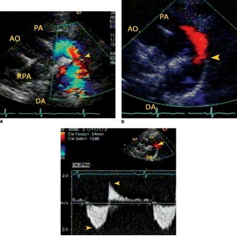 Two Dimensional Transthoracic Echocardiography In An Adult With Patent