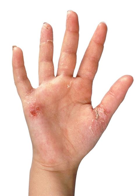 Girls Hand Affected By Contact Dermatitis Photograph By Jim Selby