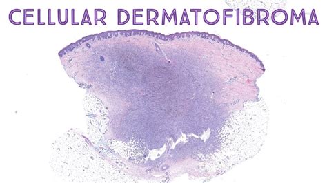 Cellular Dermatofibroma Dermpath Pathology Dermatology Youtube