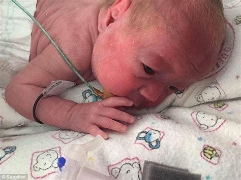Premature Baby Born Weighing Just 600g Survives Meningitis And Nine