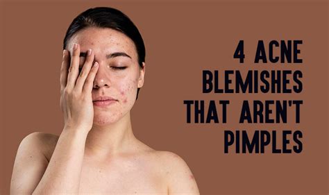 4 Acne Blemishes That Arent Pimples Neostopzone