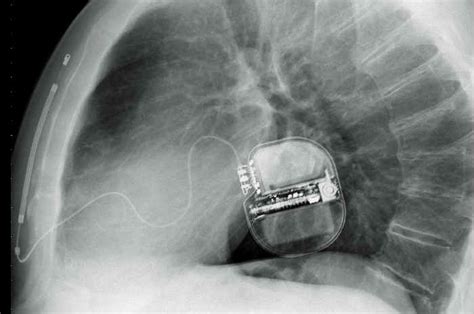 (despre un organ legislativ) care este alcătuit din două adunări reprezentative. Defibrillatore cardiaco impiantabile: l'asso nella tasca