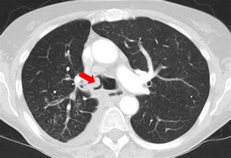 Weil die anzeichen einer herzmuskelentzündung oft wenig spezifisch sind, werden sie oft übersehen. Pneumologie - unsere Krankheitsbilder im Röntgenbild