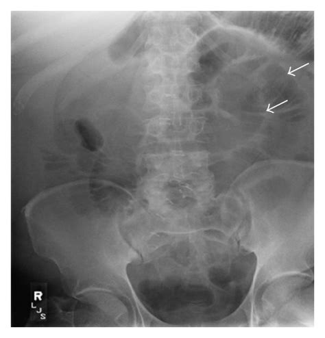 X Ray Abdomen A Supine Abdominal Radiograph Shows Dilated Small