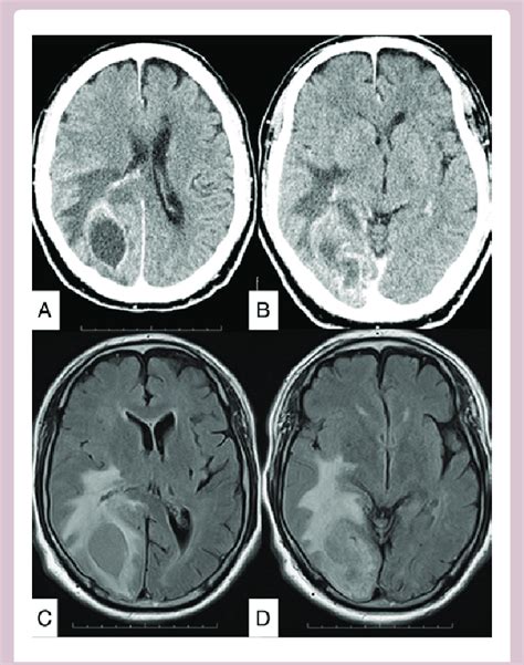 A And B Preoperative Axial Contrast Enhanced Ct Scans Demonstrate A