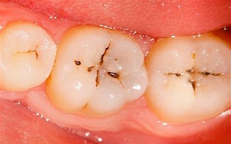 A telltale sign that you are dealing with a cavity is if you notice any holes on the surface of your teeth. Jeff M. Morrison & Associates DDS, PA: Most Common Place ...