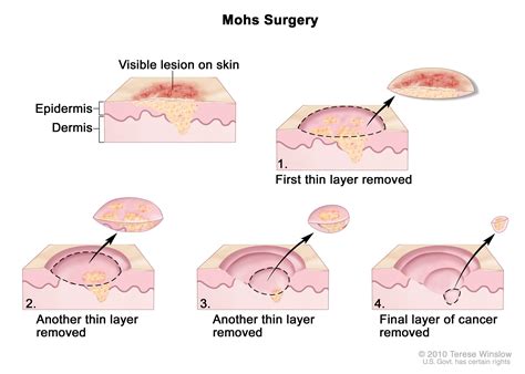 In the early stages, mouth cancer rarely causes any pain. Sarcoma cancer final stages, Male throat cancer from hpv
