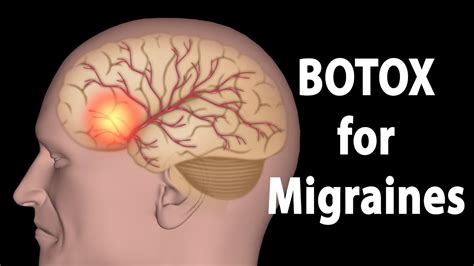 Migraine Botox Injection Sites Diagram