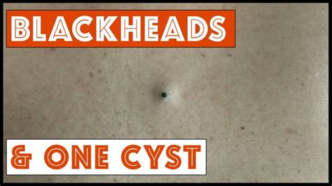 Blackheads And One Cyst Youtube Blackheads Cysts Pimple Popping