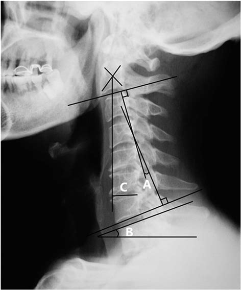 Radiographic Measurements A C27 Cobb Angle B T1 Slope C C27