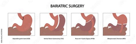 Bariatric Surgery Different Types Of Bariatric Procedures Stock
