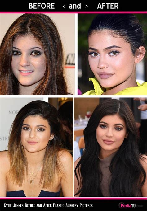 Kylie Jenner Before and After Plastic Surgery Pictures in ...