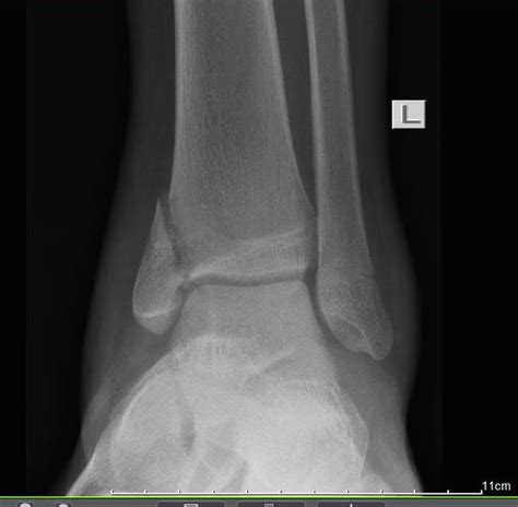 Ankle Fractures Trauma