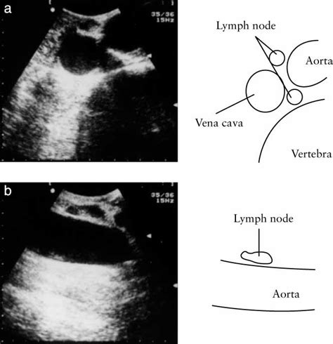 Assessment Of Paraaortic Lymph Nodes By Intraoperative Sonography In Images