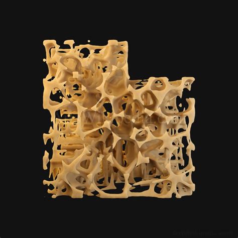 3d Trabeculae Of Spongy Bone Osteoporosis Histology