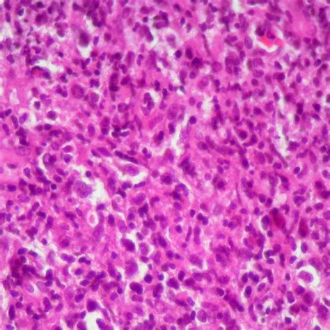 Pdf Angiocentric Nasal T Cell Lymphoma In A Patient With Idiopathic