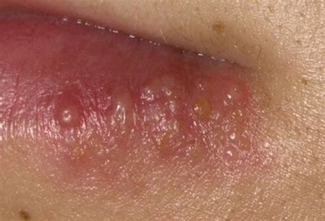 A simplex virus, herpes (hsv) causes millions of people to be in pain and possible embarrassment. Pictures of Skin Diseases and Problems - Herpes Simplex ...