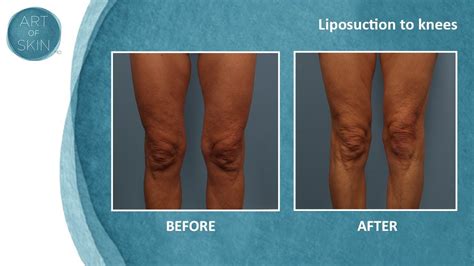 Lipo Of Knees Youtube