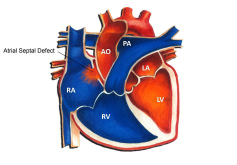 Atrial Septal Defect Pediatric Heart Specialists