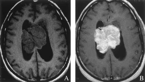 T1 Weighted Mri Without A And With B Gadolinium Of A Large Central
