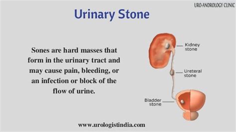 Urinary Stone Treatment In Chennai Urology Clinic In Tamilnadu