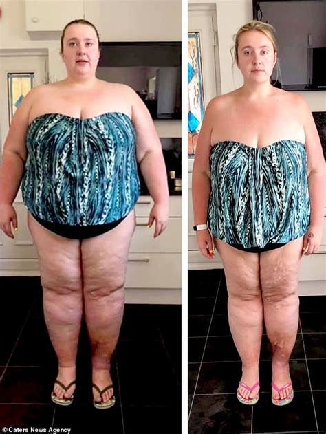 Woman Left With 15lbs Of Saggy Skin After Losing 12st Hopes To Raise