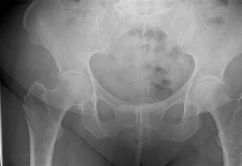 A Case Of Concealed Extracapsular Subtrochanteric Hip Fracture Orthogate