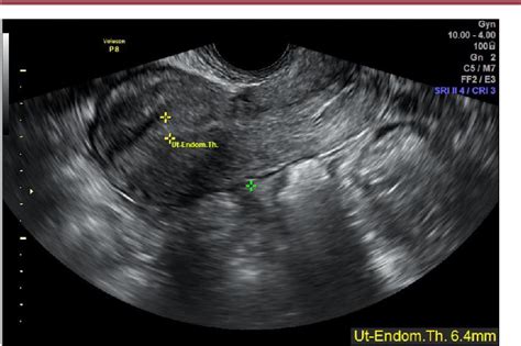Figure 3 From Lower Uterine Section Transverse Incision Defect And