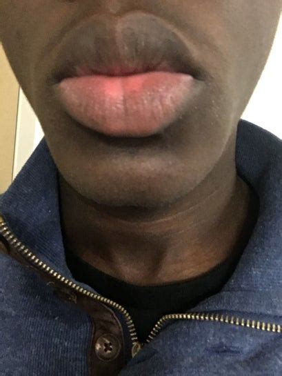 Discoloration Of The Lips