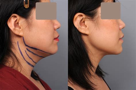Neck Liposuction Chin Liposuction Before And After Photo Gallery
