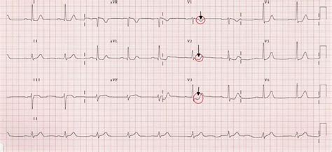 How To Read An Ecg Steps How To Do Thing