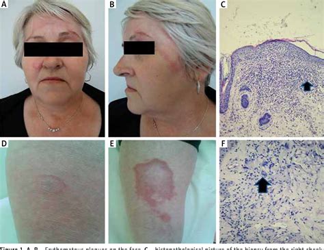 Figure 1 From Granulomatous Skin Disease With A Histological Pattern Of