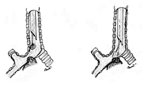 Airway Stenting Ctsnet