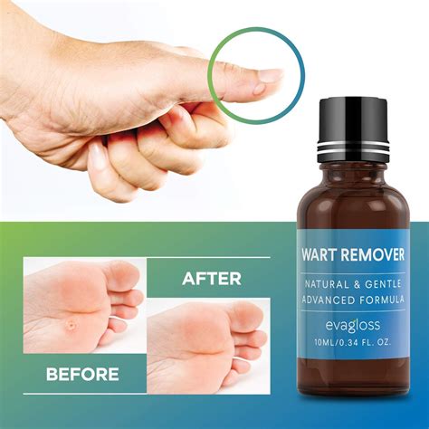 Natural Wart Remover Maximum Strength Painlessly Removes Plantar