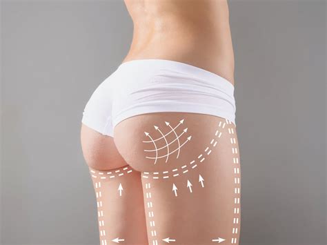 Brazilian Butt Lifts Get Guideline Makeover To Make