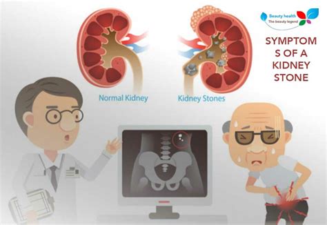 Symptoms Of A Kidney Stone 3 Signs That You Have It