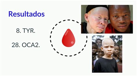 Albinismo oculocutáneo YouTube